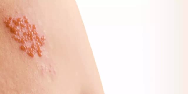 Jakie leki na półpaśca bez recepty skutecznie złagodzą ból i objawy? Jakie leki na półpaśca bez recepty skutecznie złagodzą ból i objawy?