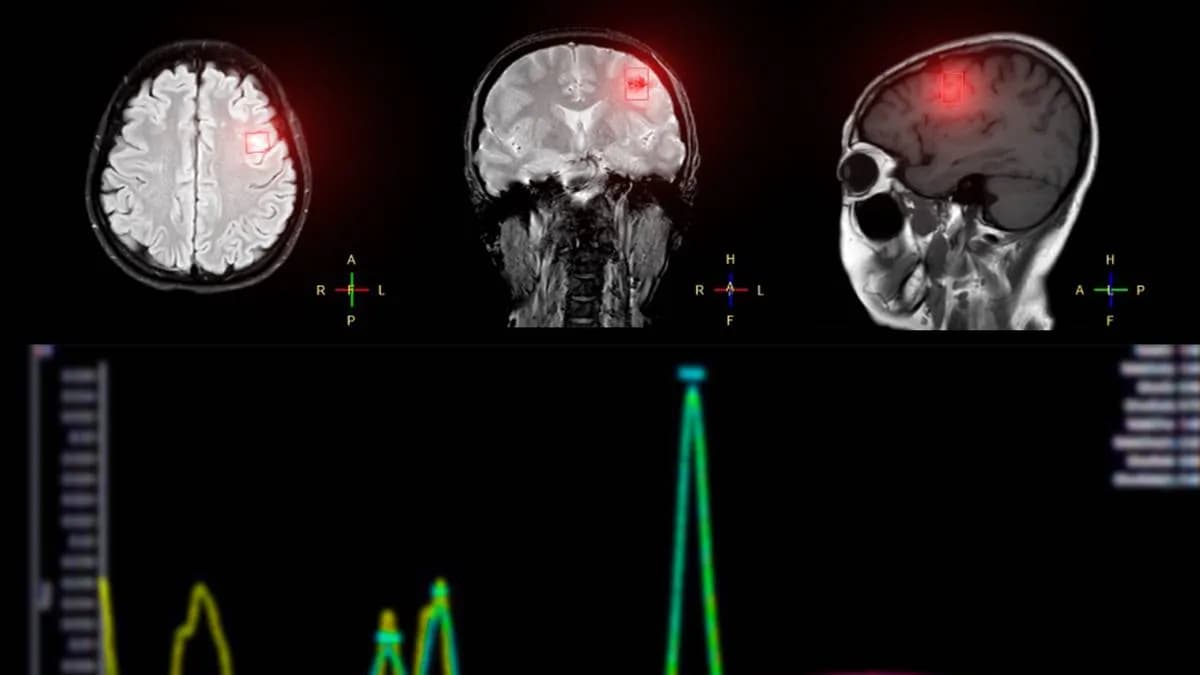 Czy tomografia wykryje udar mózgu? Kluczowe informacje o diagnostyce Czy tomografia wykryje udar mózgu? Kluczowe informacje o diagnostyce