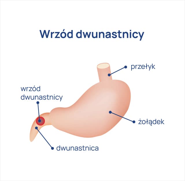 Jakie leki na wrzody dwunastnicy skutecznie złagodzą objawy? Jakie leki na wrzody dwunastnicy skutecznie złagodzą objawy?